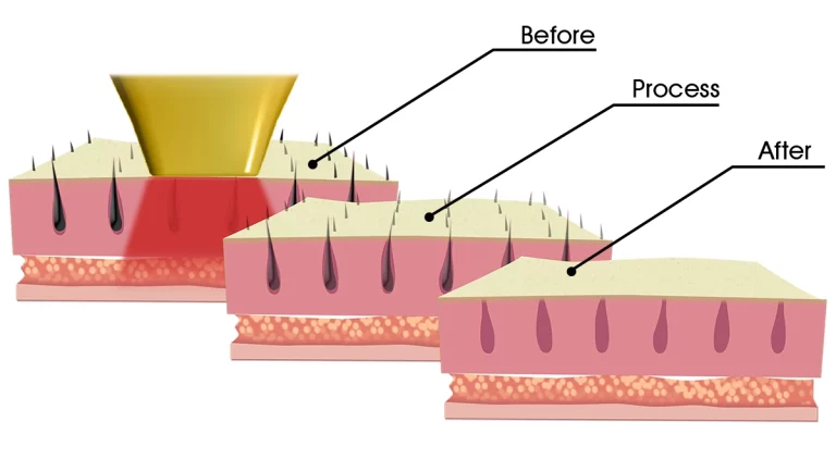 How laser technology works on hair follicles to removal unwanted hair efficiently.