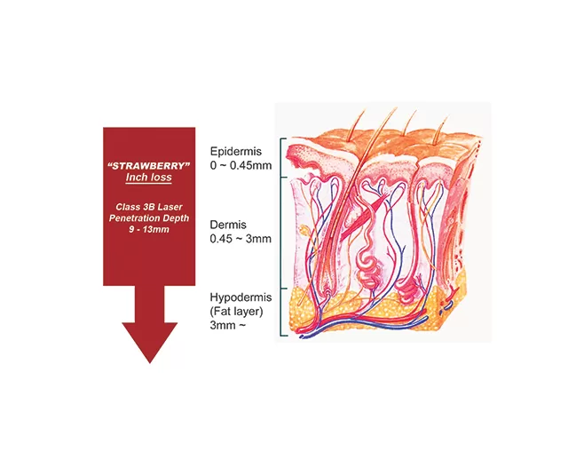 Laser lipolysis' penetration depth in different dermic layers