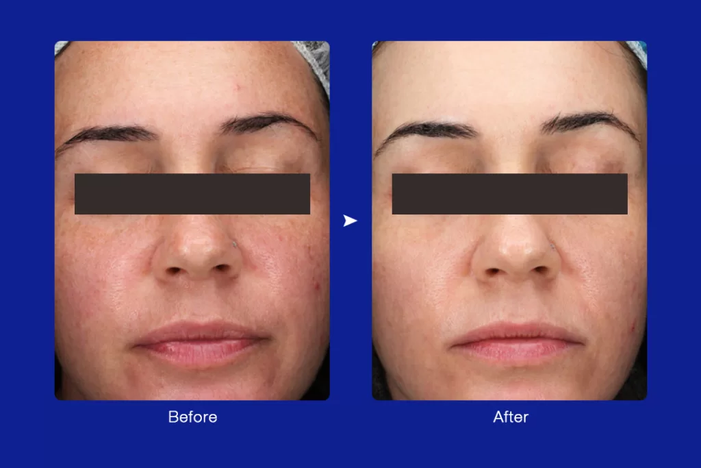 before & after of hydra dermabrasion treatment