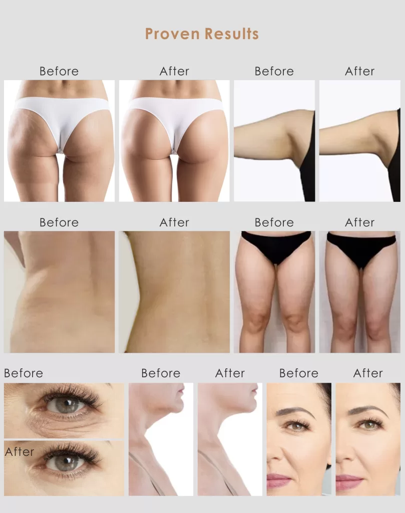 before and after of Velashape treatment