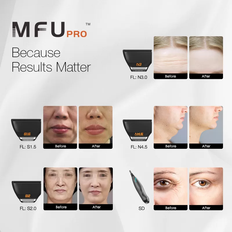 HIFU facial treatment areas