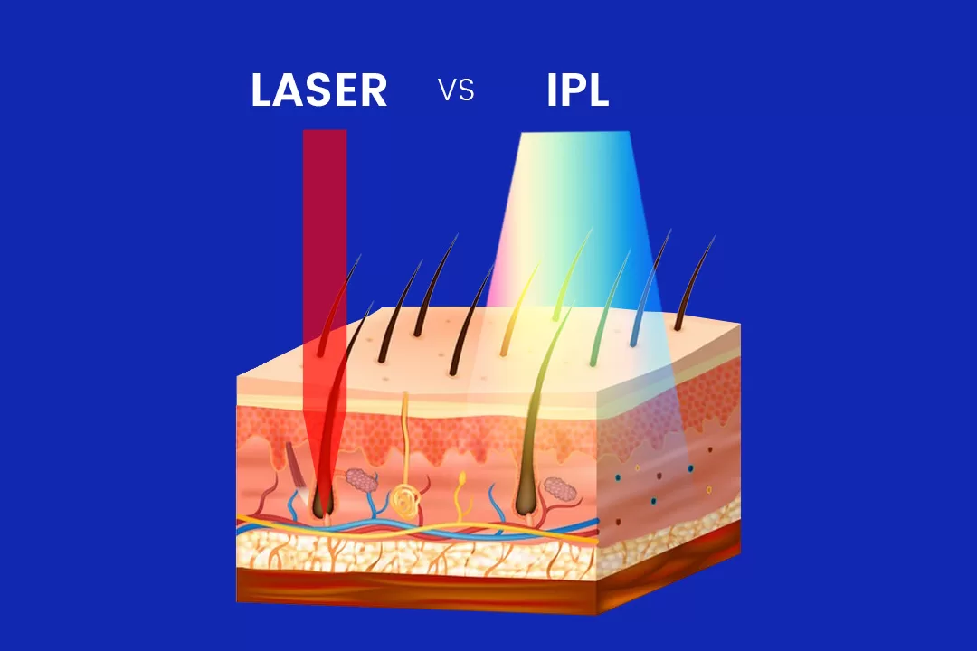 LAER vs. IPL hair removal light source