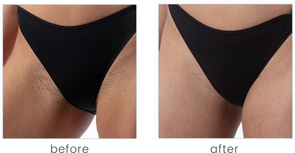 Before and after of EosICE® hair removal treatment on the bikini line