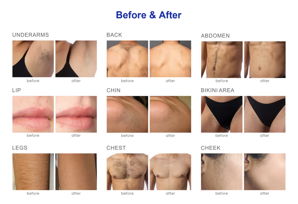 Before and after of IPL hair removal treatment effect on different body areas: underarms, back, abdomen, lip, chin, bikini area, legs, chest, and cheek.