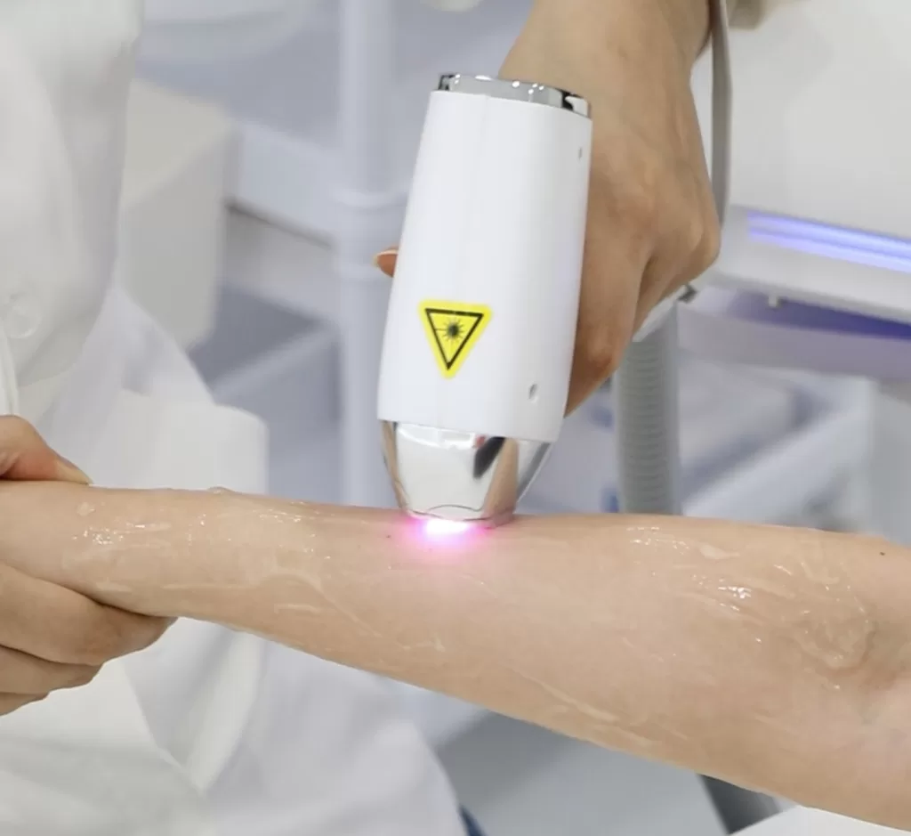 Perform hair laser removal treatment on the arm