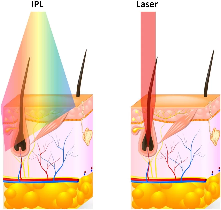 The difference of IPL and hair removal on how it works when light is emitted to the hair follicles。