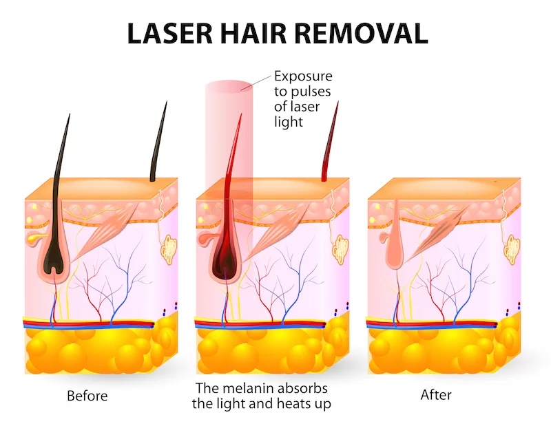 Laser hair removal working principle  figure