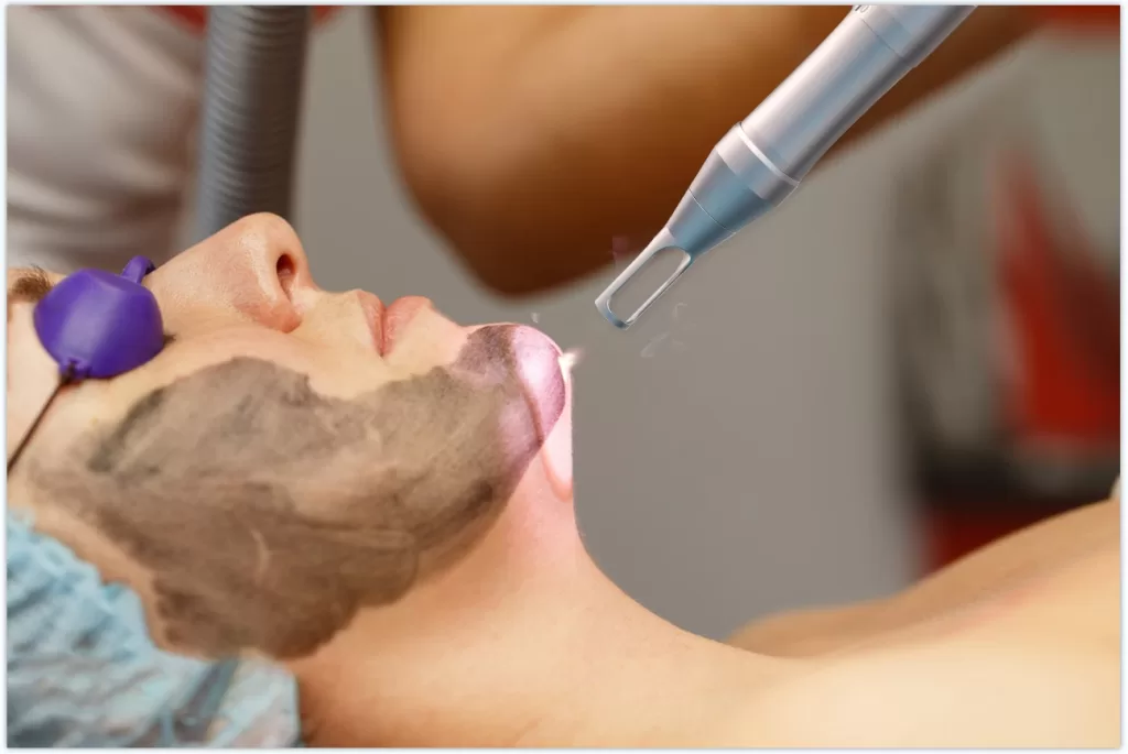 pico laser machine treatment on face