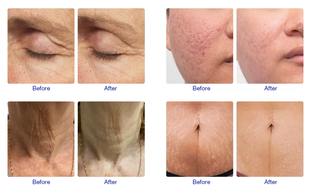 Before and after pictures of four patients with different types of skin problems using microneedles