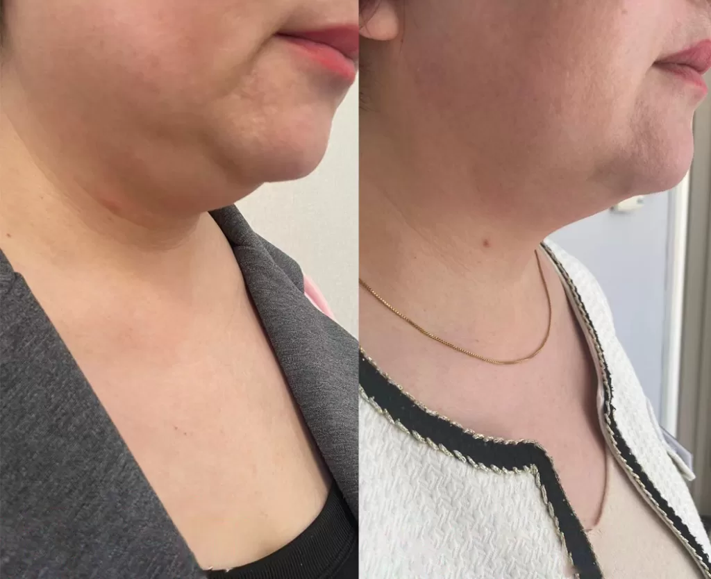 Side view: The effective coolsculpting double chin before and after result after several sessions in 3 months.