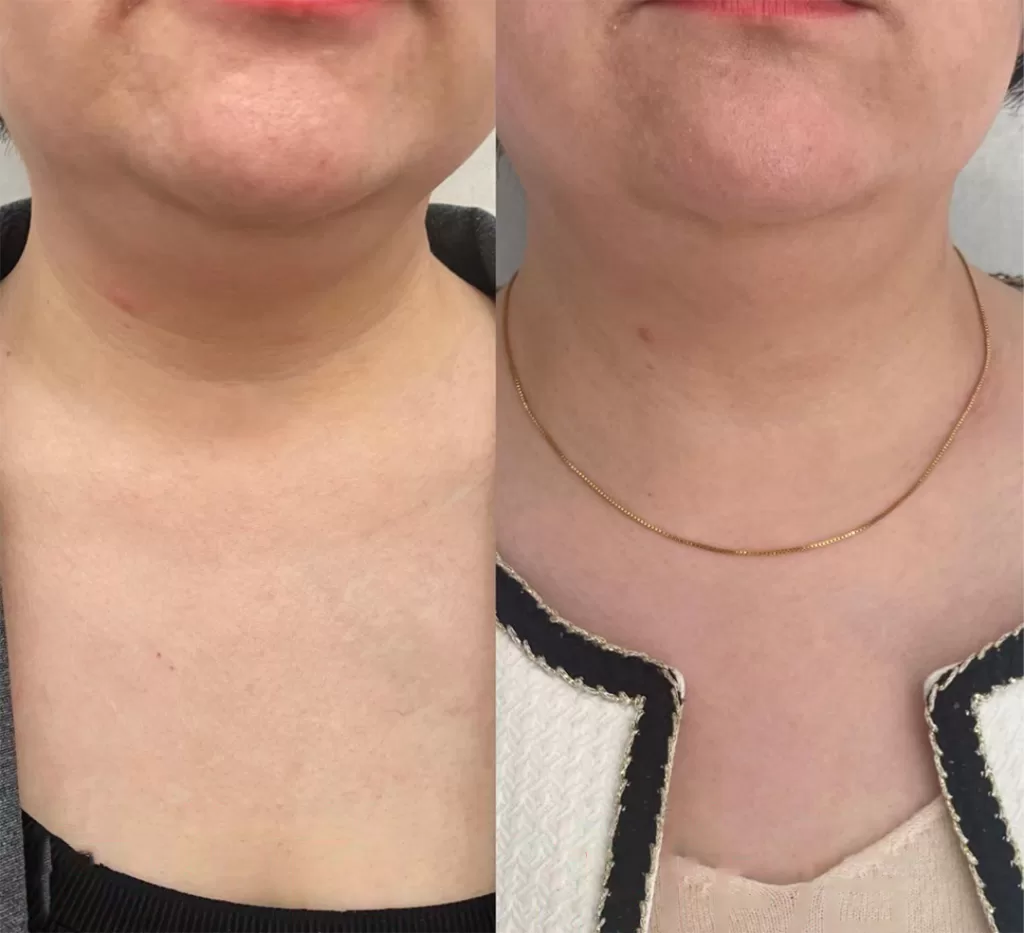 Front view: The effective coolsculpting double chin before and after result after several sessions in 3 months.