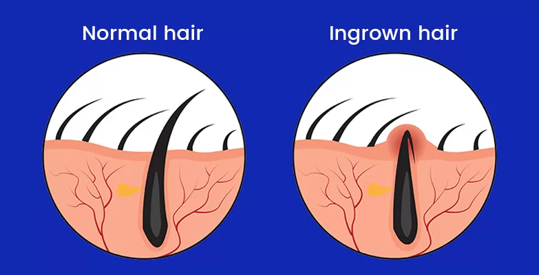 Normal hair vs. ingrown hair