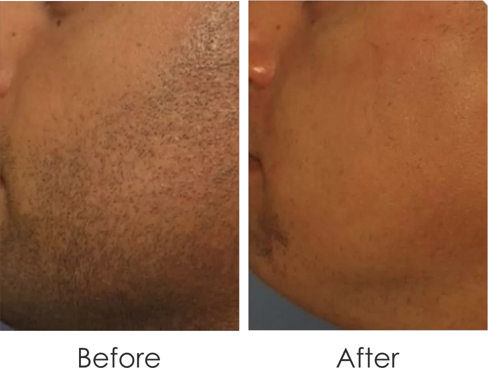 before & after of laser treatment for check hair