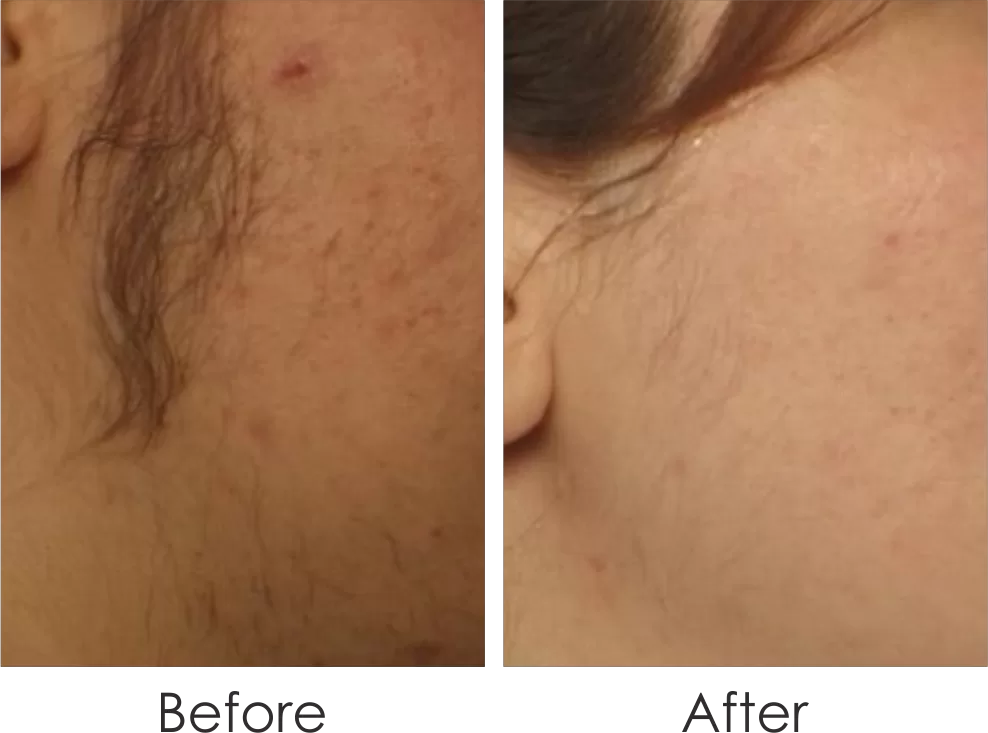 before & after of laser treatment for  hair on the temples