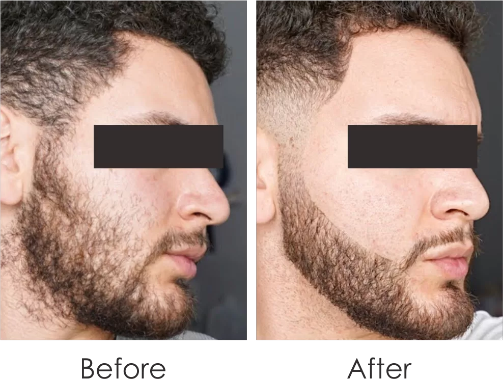 before & after of laser treatment for sideburns hair