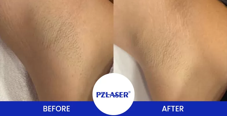 laser hair removal for ingrown hair before and after