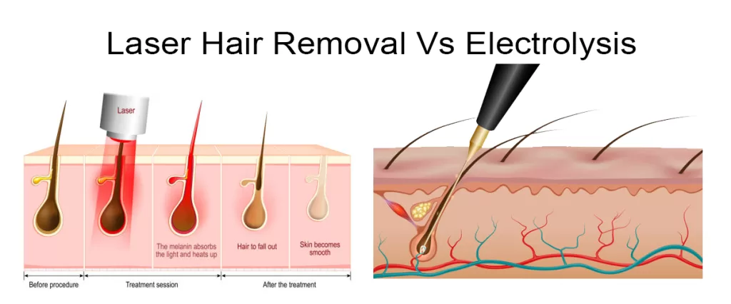 laser hair removal vs electrolysis hair removal working principle