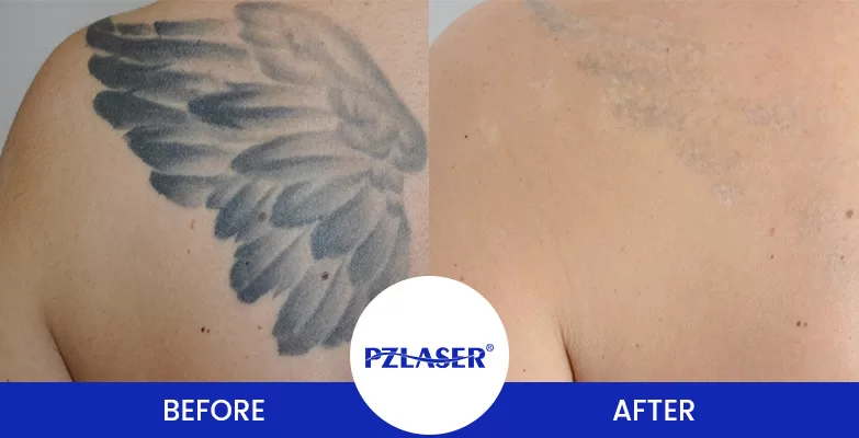 the laser tattoo removal before and after pics on man's back