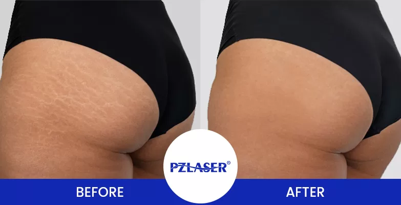 microneedling stretch marks on buttocks before and after