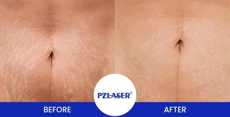 microneedling stretch marks on the abdomen before and after