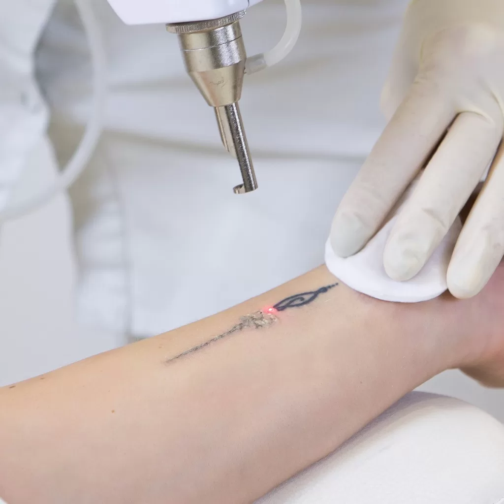 pico laser tattoo removal treatment on the left arm