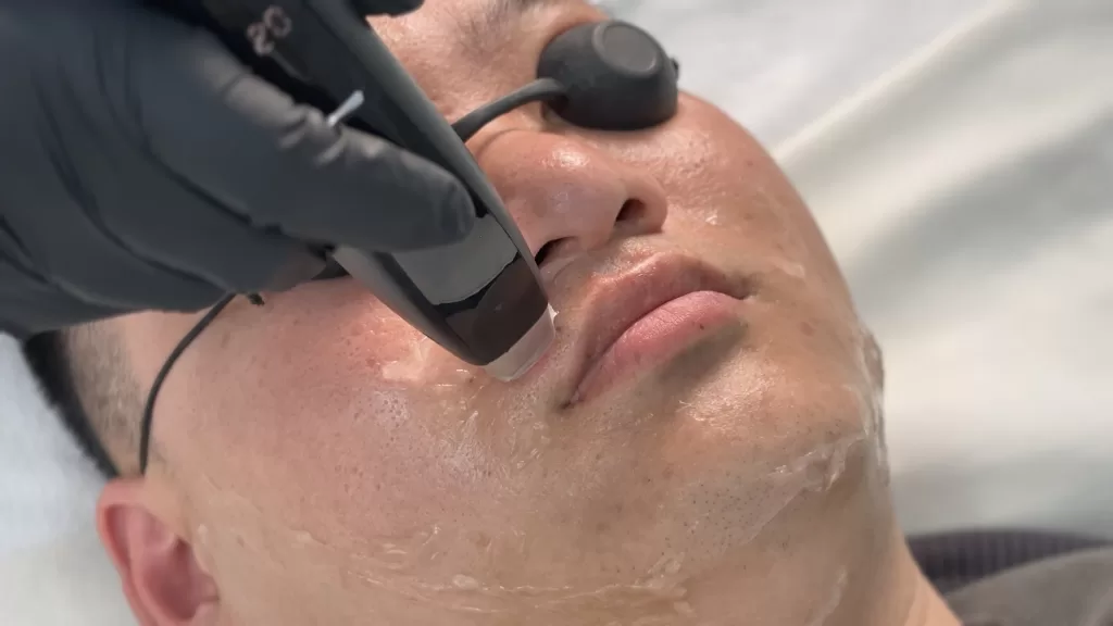 The laser treatment on the male's upper lip area.